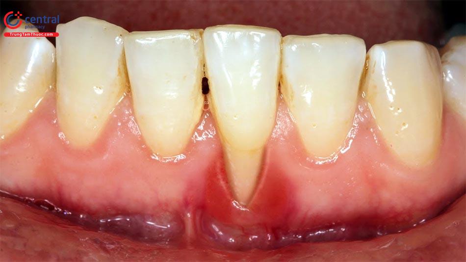 Bệnh trụt nướu răng: nguyên nhân gây bệnh và điều trị