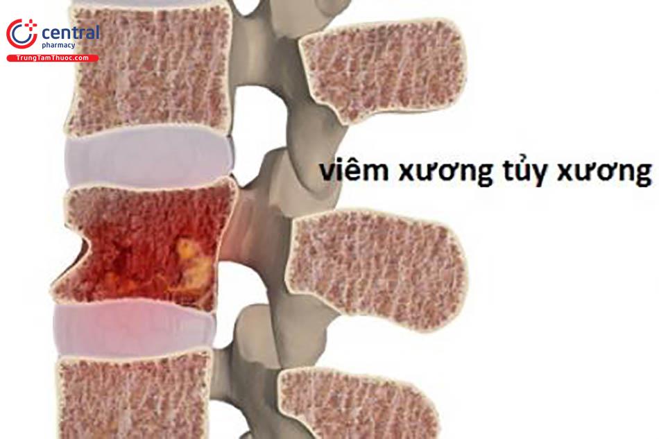 Bệnh viêm tủy xương: nguyên nhân, chẩn đoán và điều trị