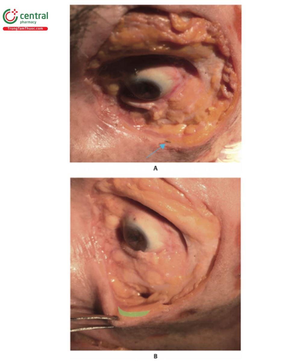 Hình 10.26 A. Bên trái khuôn mặt của xác tươi được bộc lộ da, lớp mỡ nông (SFP), cơ vòng mắt (OM), lớp mỡ dưới cơ vòng mắt trong (SOOF) và viền gò má (MAr). Có thể nhìn thấy đầu của cannula 25G x 40 mm trong SFP, nơi sản phẩm được tiêm (mũi tên màu xanh). Khi mất thể tích nghiêm trọng, mặt phẳng sâu hơn (SOOF và khoang trước gò má) cũng có thể được chọn để điều trị. B. Hình A với HA (màu xanh lá cây) ở lớp SFP má trong.