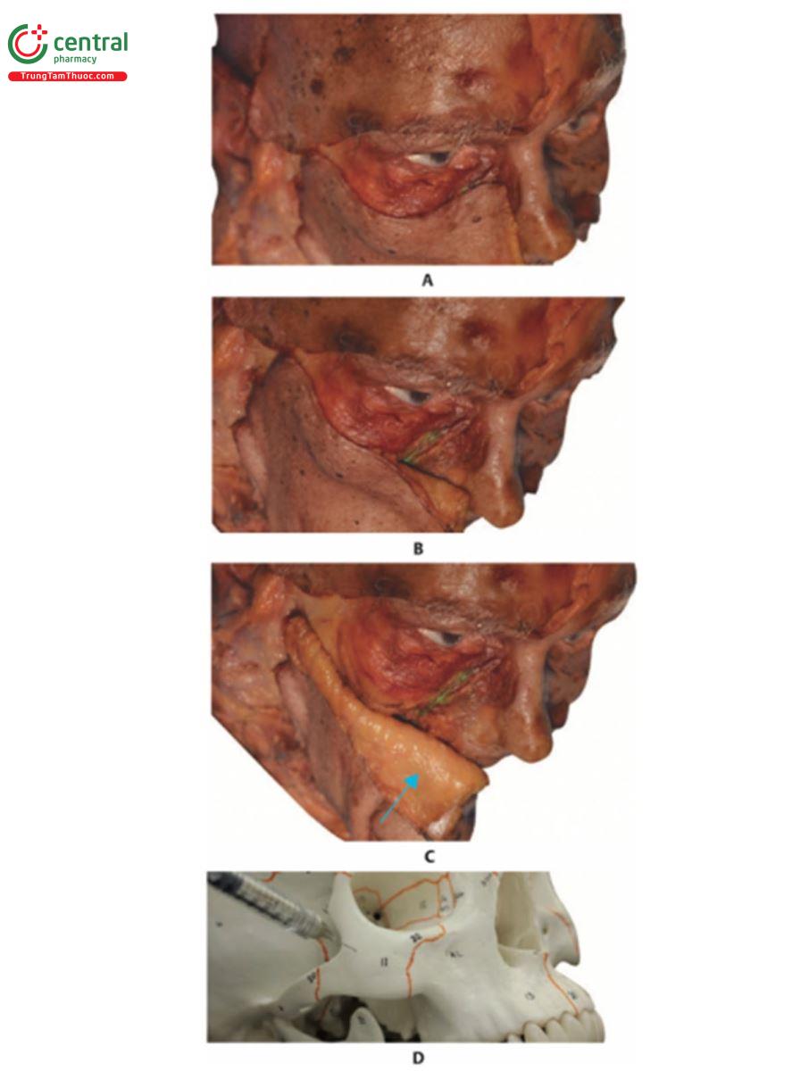 Hình 10.28 A. Bên phải khuôn mặt xác tươi bộc lộ phần mi mắt của cơ vòng mắt (OM). B. Da và lớp mỡ nông (SFP) bị gấp lại và OM lộ ra nhiều hơn về phía trong. C. Bên phải khuôn mặt xác tươi với da được gấp lại, để lộ SFP của 1/3 giữa khuôn mặt (mũi tên xanh). Toàn bộ OM (phần mí mắt và ổ mắt) có thể nhìn thấy được. D. Hình nghiêng giữa bên phải của hộp sọ với một ống tiêm cho thấy sử dụng ở mặt phẳng trên màng xương của xương gò má.