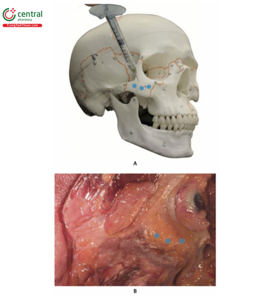 Hình 10.30 A. Hình nghiêng giữa bên phải của hộp sọ với ống tiêm mô phỏng việc tiêm bolus vào mặt phẳng trên màng xương của xương gò má. B. Bên phải khuôn mặt xác tươi trong đó da, lớp mỡ nông (SFP), cơ vòng mắt (OM) và một phần của lớp mỡ dưới cơ vòng mắt (SOOF) đã được gấp lại. Có thể nhìn thấy một phần của lớp SOOF và vòm gò má. Ba vòng tròn màu xanh đánh dấu nơi sản phẩm được tiêm vào mặt phẳng trên màng xương.