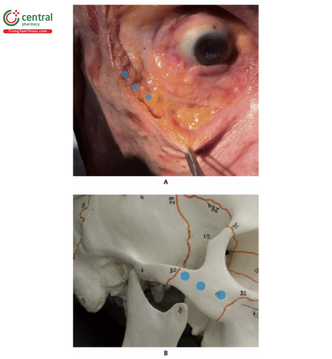 Hình 10.34 A. Bên phải khuôn mặt xác tươi bộc lộ da, lớp mỡ nông (SFP), cơ vòng mắt (OM), lớp mỡ dưới cơ vòng mắt (SOOF) và vòm gò má (MAr). Ba vòng tròn màu xanh lam giữa SOOF và MAr cho biết nơi sản phẩm được tiêm vào mặt phẳng dưới cơ, ở vùng gò má. B. Hình nghiêng giữa bên phải của hộp sọ với ba vòng tròn màu xanh đánh dấu nơi sản phẩm được tiêm vào xương gò má, trong mặt phẳng dưới cơ.