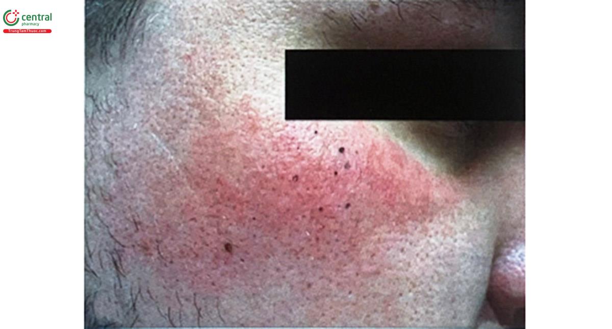Hình 6.28. Mồ hôi màu đen vùng má khi gắng sức nhẹ (Nguồn: Wang A và cộng sự, 2014, International Society of Dermatopathology)