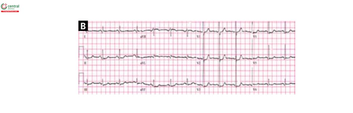 Hình 5B. ST chênh xuống ở Vị cho tới V6 và DII, DII và aVF; chênh nhiều nhất ở V2 và V3. Ngoài ra, R cao thấy ở V1 và V2 kèm sóng Q thấy ở DI và aVL kèm ST chênh lên ở aVL. Ở bệnh nhân đau ngực dữ dội kéo dài, gợi ý nhồi máu cơ tim thành sau bên. Chụp mạch vành cho thấy tắc hoàn toàn nhánh 2 động mạch bờ