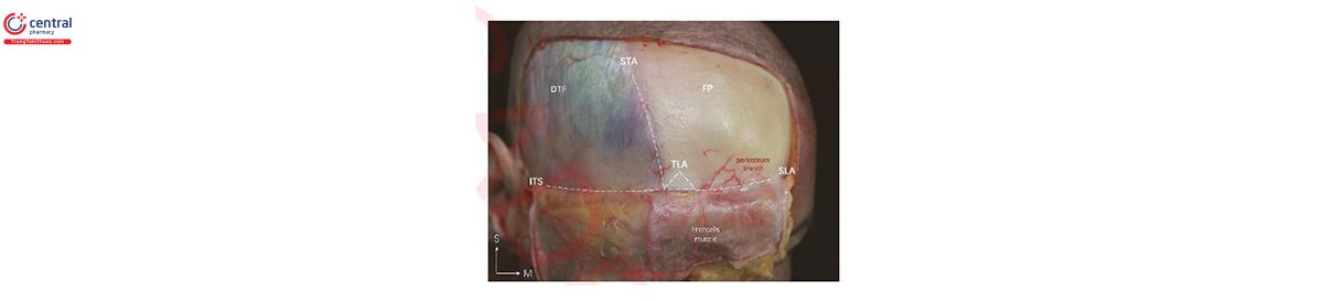  lình 1 Mặt trước quan sát thấy phần bám dính dây chằng thái dương (vùng tam giác) (TLA). TLA phát sinh từ màng xương trán (FP) dưới cơ trán. Ít mạch máu nằm trong vùng tam giác TLA được hình thành bởi sự hợp lưu của 3 dây chằng thật: vách thái dương trên (STA) ở trên, vách thái dương dưới (ITS) ở ngoài và phầm bám dính dây chẳng trên 0 mắt (SLA) ở trong. Cân thái dương sâu (DTF) và STA được đánh dấu. M, phía trong; s, phía trên.