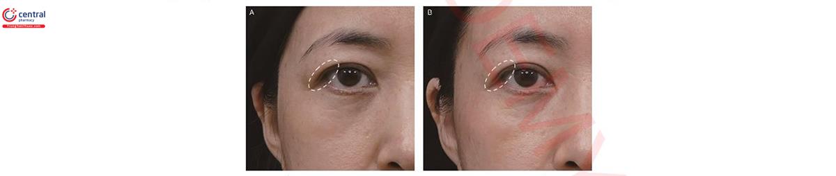 Hình 5 BN nữ 46 tuồi này trong hình (A) trước khi tiêm và (B) 1 tuần sau khi tiêm 0.15cc chất làm đầy ở phần dày lên của ồ mắt ngoài. Khóe mắt ngoài và da mí mắt trôn được nâng lên (vòng tròn màu trắng).