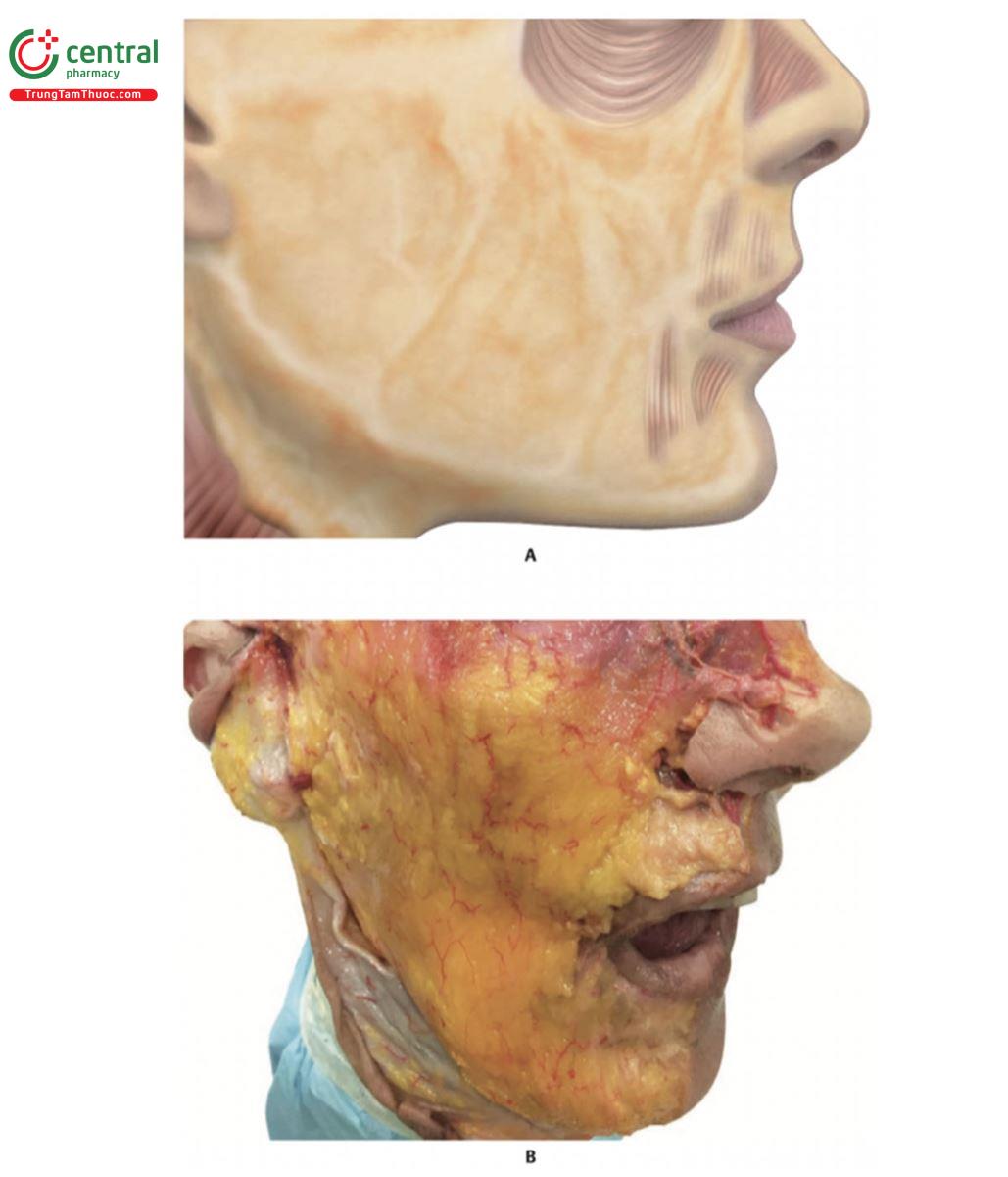 Hình 17.11 A. Bên phải 1/3 dưới khuôn mặt sau khi loại bỏ da, để lộ các khối mỡ nông (SFP). B. Bên phải  của xác tươi, cho thấy các SFP.
