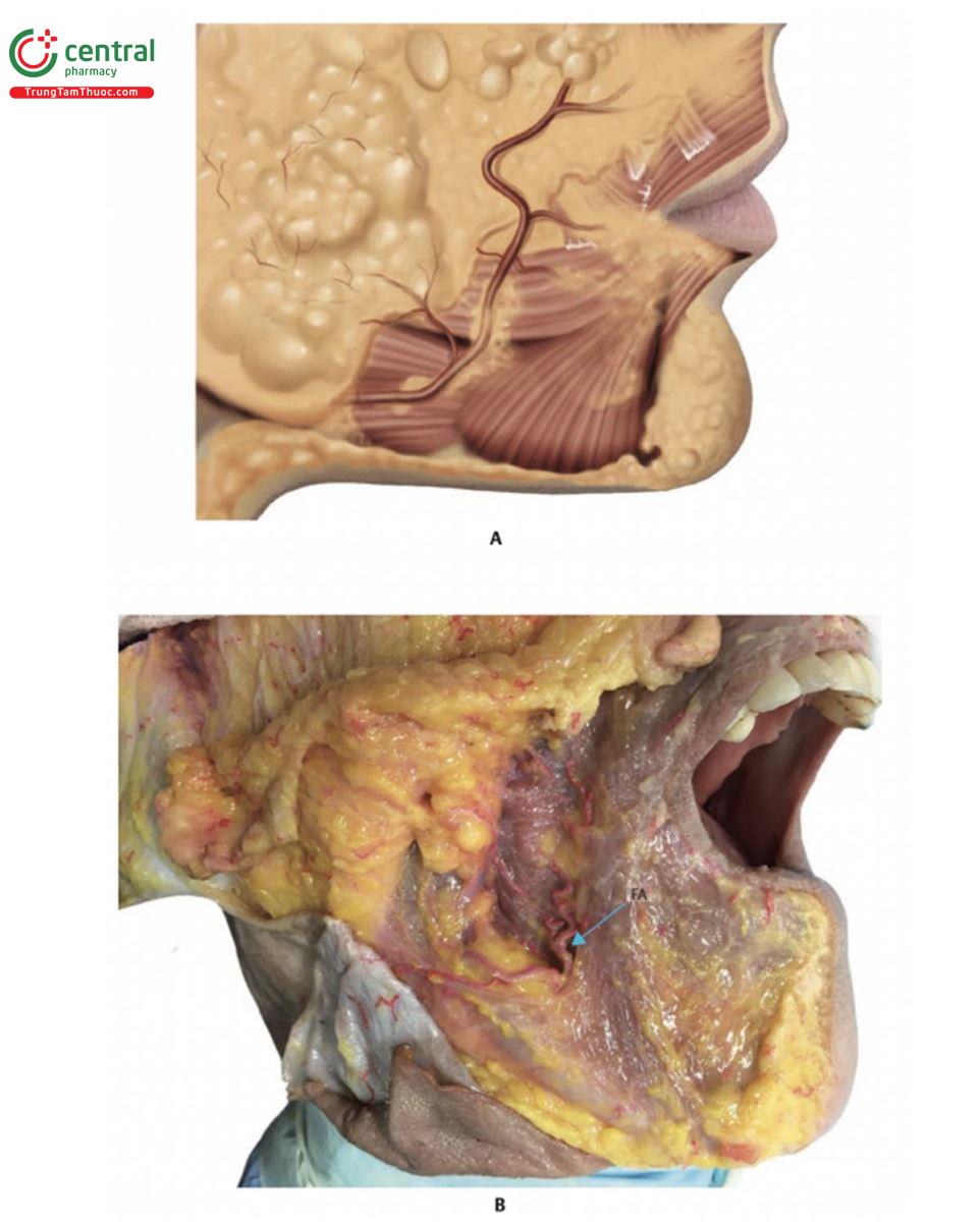 Hình 17.14 A. Bên phải 1/3 dưới khuôn mặt sau khi loại bỏ da, để lộ các lớp mỡ sâu (DFP) bên dưới động mạch mặt (FA) cùng các nhánh của nó. Có thể nhìn thấy các cơ sau: cơ vòng miệng (OOM), cơ cười, cơ hạ góc miệng (DMAM), cơ hạ môi và cơ platysma. B. Bên phải của xác tươi hiển thị chính xác những gì được  mô tả ở phần A, tập trung vào FA (mũi tên màu xanh).