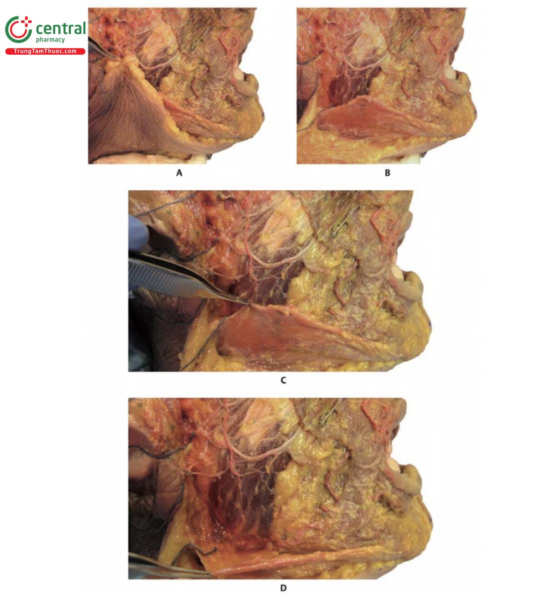 Hình 17.16 A. Bên phải 1/3 dưới khuôn mặt của xác tươi với lớp da được kéo lên trên phần cơ platysma. B. Hình ảnh sau khi loại bỏ da, có thể nhìn thấy cơ platysma bao phủ một phần cơ cắn. C. Hình ảnh với cơ platysma được kéo lên và che đi một phần cơ cắn. D. Hình ảnh với cơ platysma được kéo ngược để lộ cơ cắn  và tuyến mang tai phía sau.
