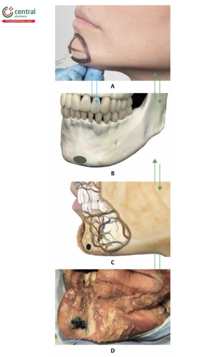 Hình 17.29 A. Kim được đưa vào mặt phẳng trên màng xương ở cằm của người mẫu. B. 1/3 dưới hộp sọ cho thấy điểm tiêm trên màng xương của chất làm đầy ở vùng cằm. C. Hình minh họa 1/3 dưới của hộp sọ cho thấy điểm tiêm chất làm đầy trên màng xương trong hình ảnh B. Lưu ý rằng ngay cả khi kim tiêm vào màng xương, sản phẩm vẫn xuyên qua MDFP và ở đó. D. Hình nghiêng 1/3 dưới của khuôn mặt của xác tươi cho thấy HA màu xanh lá, được tiêm bằng kim vào mặt phẳng trên màng xương của cằm. Lưu ý rằng ngay cả khi  kim tiêm vào màng xương, sản phẩm vẫn xuyên qua MDFP và ở đó.