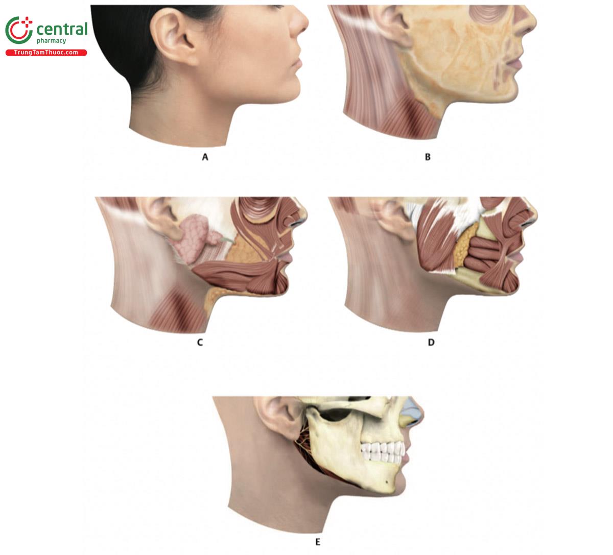 Hình 17.5 A. Nhìn từ bên phải của khuôn mặt. B. Sau khi loại bỏ da, cho thấy các lớp mỡ nông (SFP). C. Sau khi loại bỏ da và SFP. Chú ý tuyến mang tai với ống dẫn tương ứng và các cơ sau: cơ gò má lớn và bé, cơ cười, cơ vòng miệng (OOM), cơ hạ góc miệng (DMAM), cơ hạ môi, cơ cằm, cơ platysma và cơ cắn. D. Cùng hình ảnh trong đó có thể nhìn thấy các cơ sau: OOM, DMAM, cơ hạ môi, cơ cằm, cơ mút và cơ cắn.  E. Cấu trúc xương hàm trên và hàm dưới.