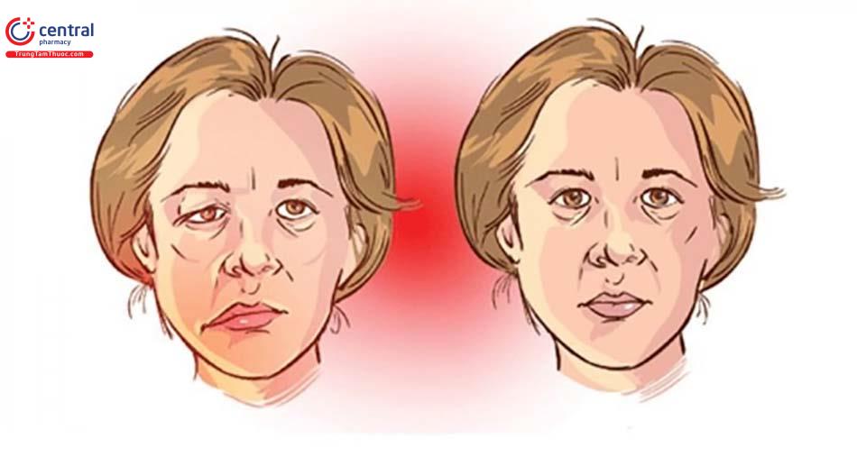 Người bệnh nhược cơ bị yếu cơ mặt với biểu hiện đặc trưng.