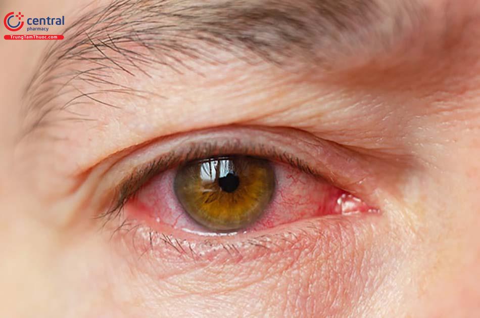 Hình ảnh bệnh đau mắt đỏ (viêm kết mạc mắt)