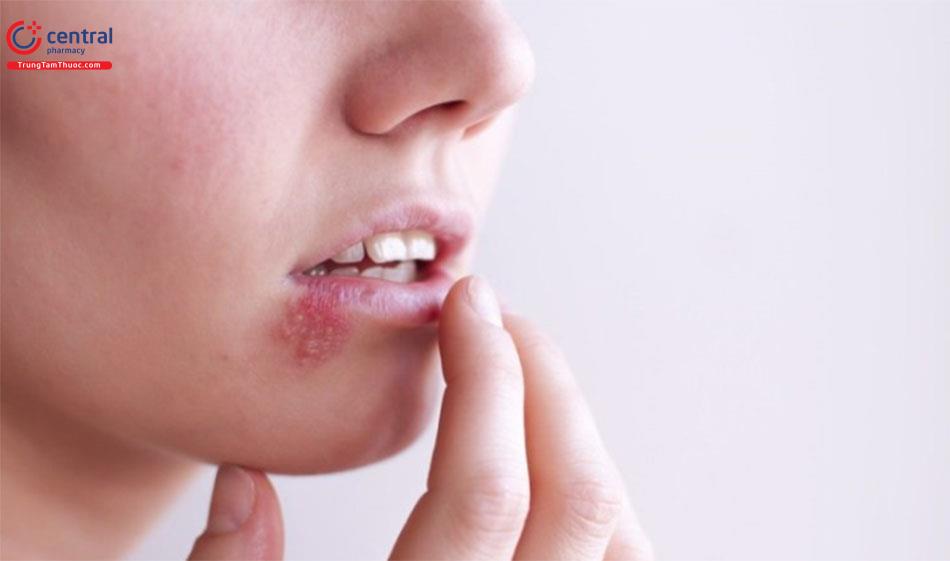 Herpes miệng do HSV type 1 gây nên