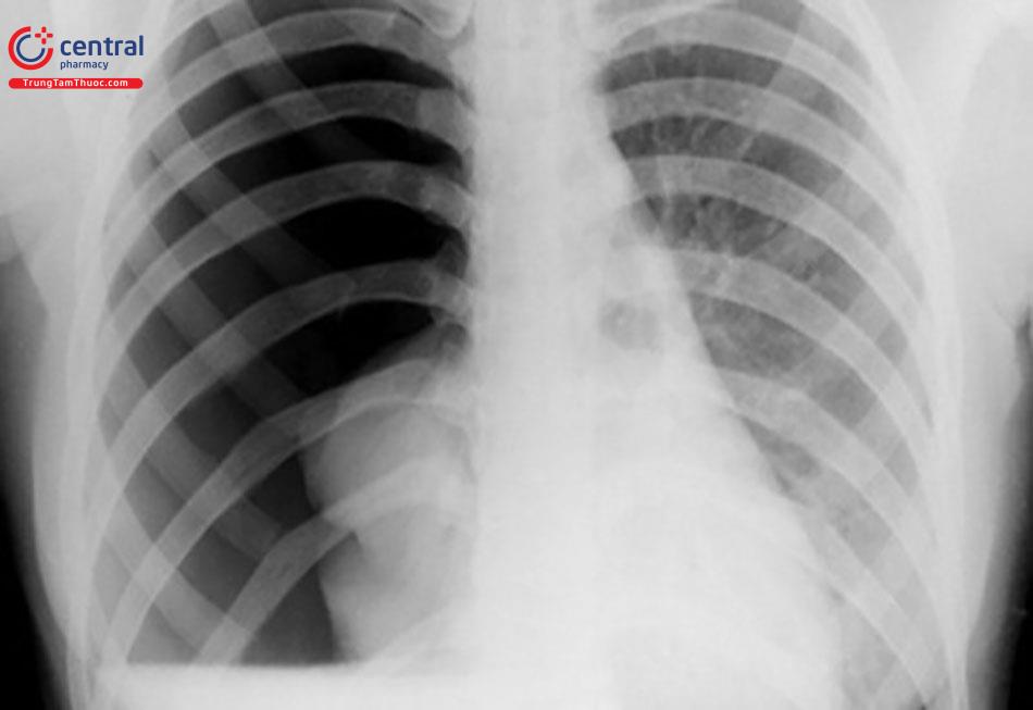 Hình ảnh X-quang