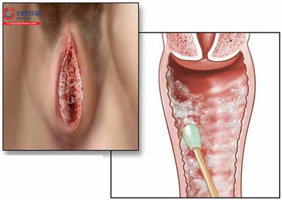 Hình ảnh viêm âm hộ âm đạo do nấm Candida