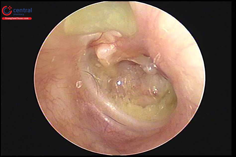 Chẩn đoán viêm tai giữa mạn tính cholesteatoma