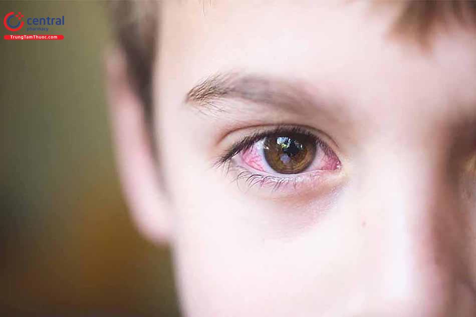Thiếu vitamin A gây các bệnh lý về mắt
