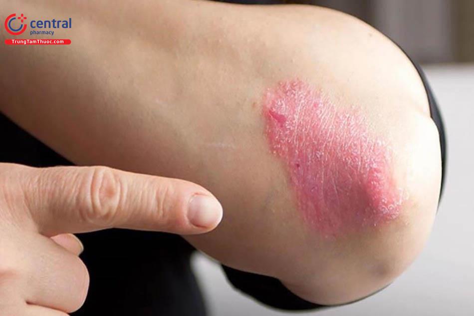 Bệnh da do nấm sợi: triệu chứng và cách điều trị