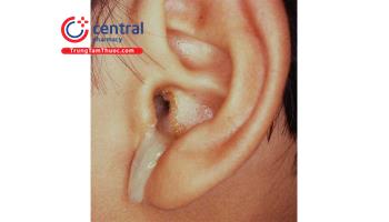 Viêm tai giữa mạn tính: nguyên nhân, chẩn đoán và điều trị