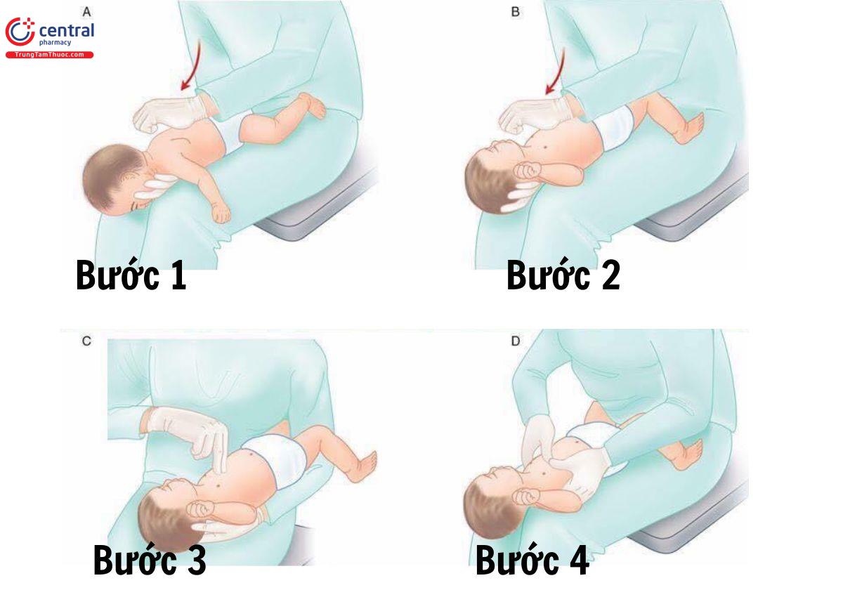 4 bước xử trí khi trẻ bị sặc sữa