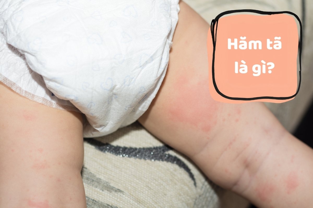Hăm tã gây đau đớn và khó chịu