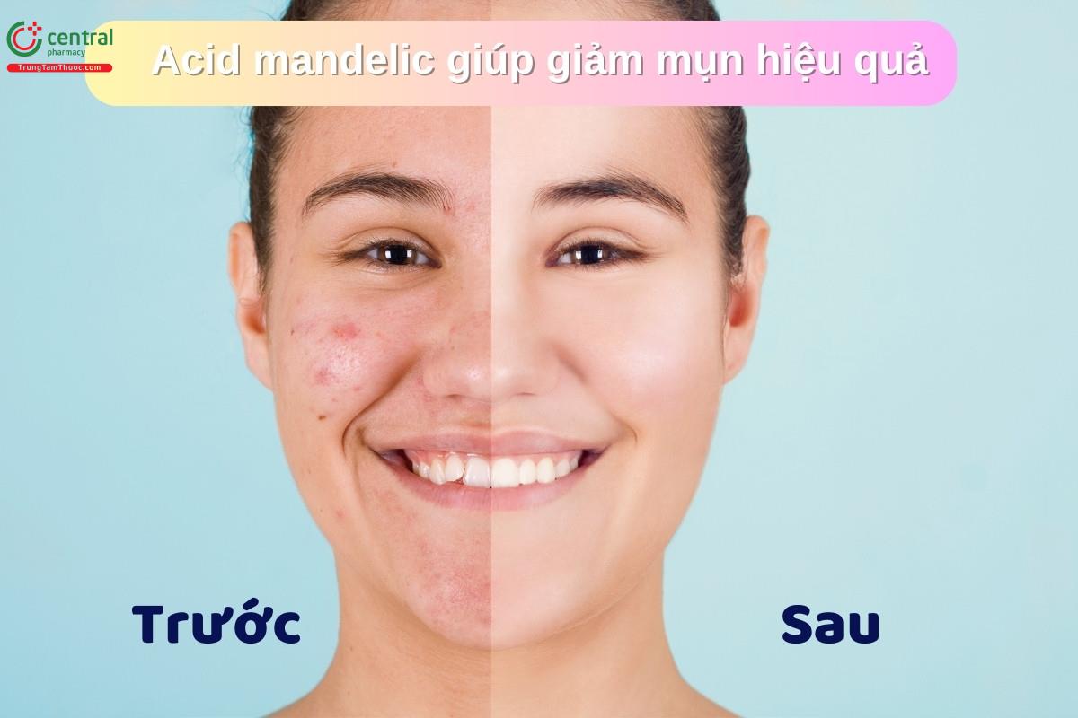 Tác dụng giảm mụn và tăng sức sống của da sau điều trị bằng Acid Mandelic