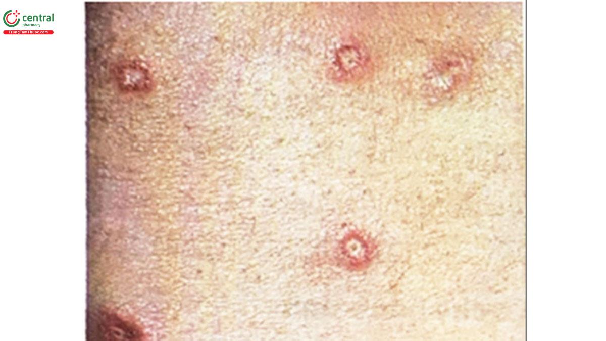 Hình 6.10. Sần điển hình với trung tâm teo da màu trắng sứ với quầng đỏ bao quanh (Nguồn: Fitzpatrick's Dermatology in General Medicine, Vol.1. 2019, Chap 146)