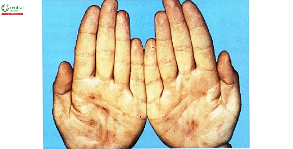 Hình 5.16. Các tổn thương sần đỏ nâu lòng bàn tay kích thước 0,5 - 1cm (Nguồn: Ingrid Woltsche - Kahr, 1999, Arch Dermatol)
