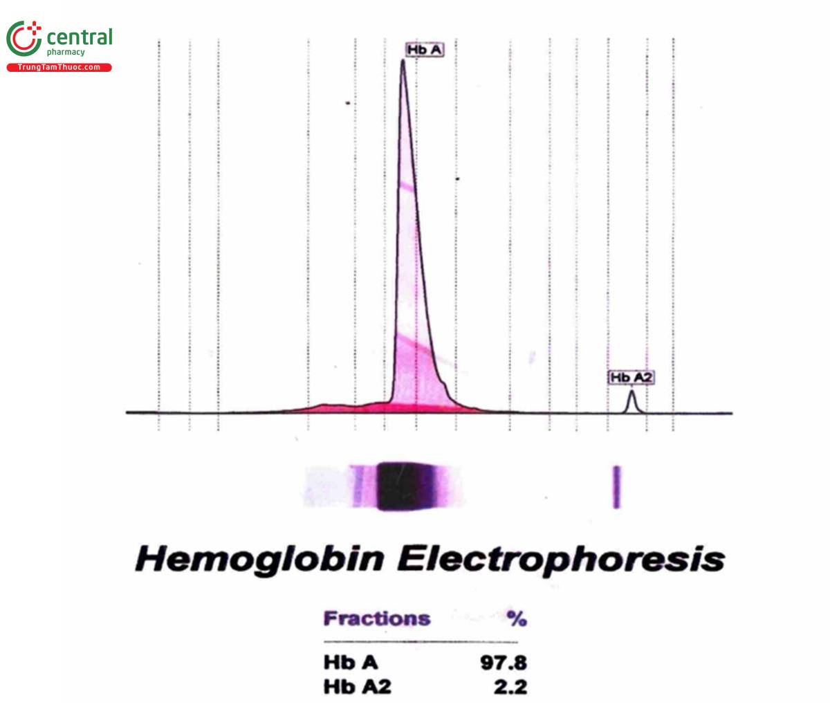 Hình 6.5. Kết quả điện di hemoglobin người bình thường (HbA: 97,8%; HbA2: 2,2%)