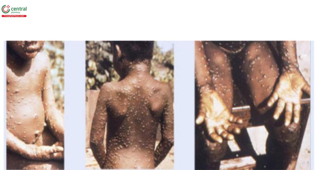 Hình 5. Hình ảnh tổn thương da của bệnh đậu mùa khỉ [7]