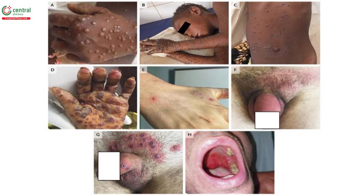 Hình 6. Đặc điểm tổn thương da và niêm mạc ở bệnh nhân đậu mùa khỉ [1].