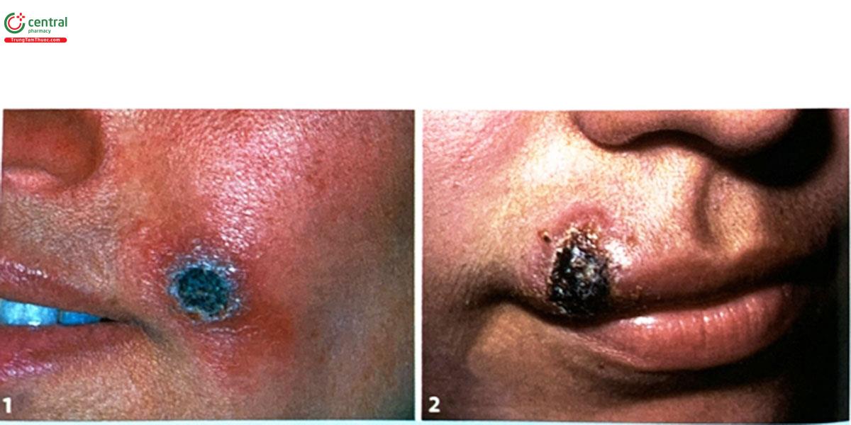 Hình 5.1. (1, 2) Tổn thương sẵn loét ở trung tâm (Nguồn: DermNet)