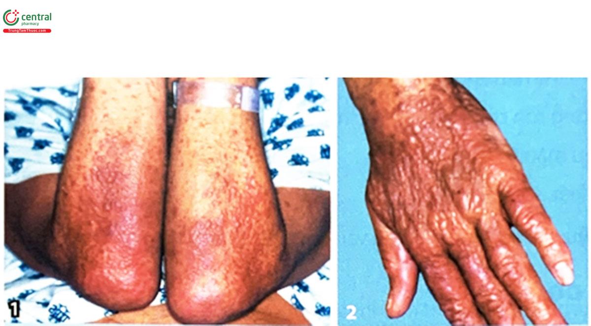 Hình 5.2. (1, 2) Tổn thương sần, mảng lan tỏa (Nguồn: Smeeta Sinha và cộng sự, 2008, The International Society of Dermatology)