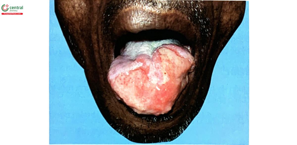 Hình 5.3. Tổn thương leishmaniasis ở lưỡi (Nguồn: DermNet)