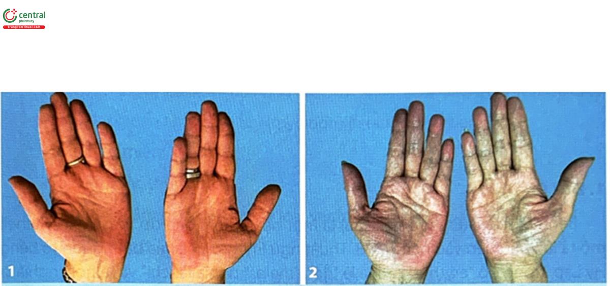 Hình 4.5. (1, 2) Dát đỏ khu trú gan bàn tay hai bên ở hai bệnh nhân nữ đến khám và điều trị tại Bệnh viện Da liễu Trung ương (Nguồn: tác giả)