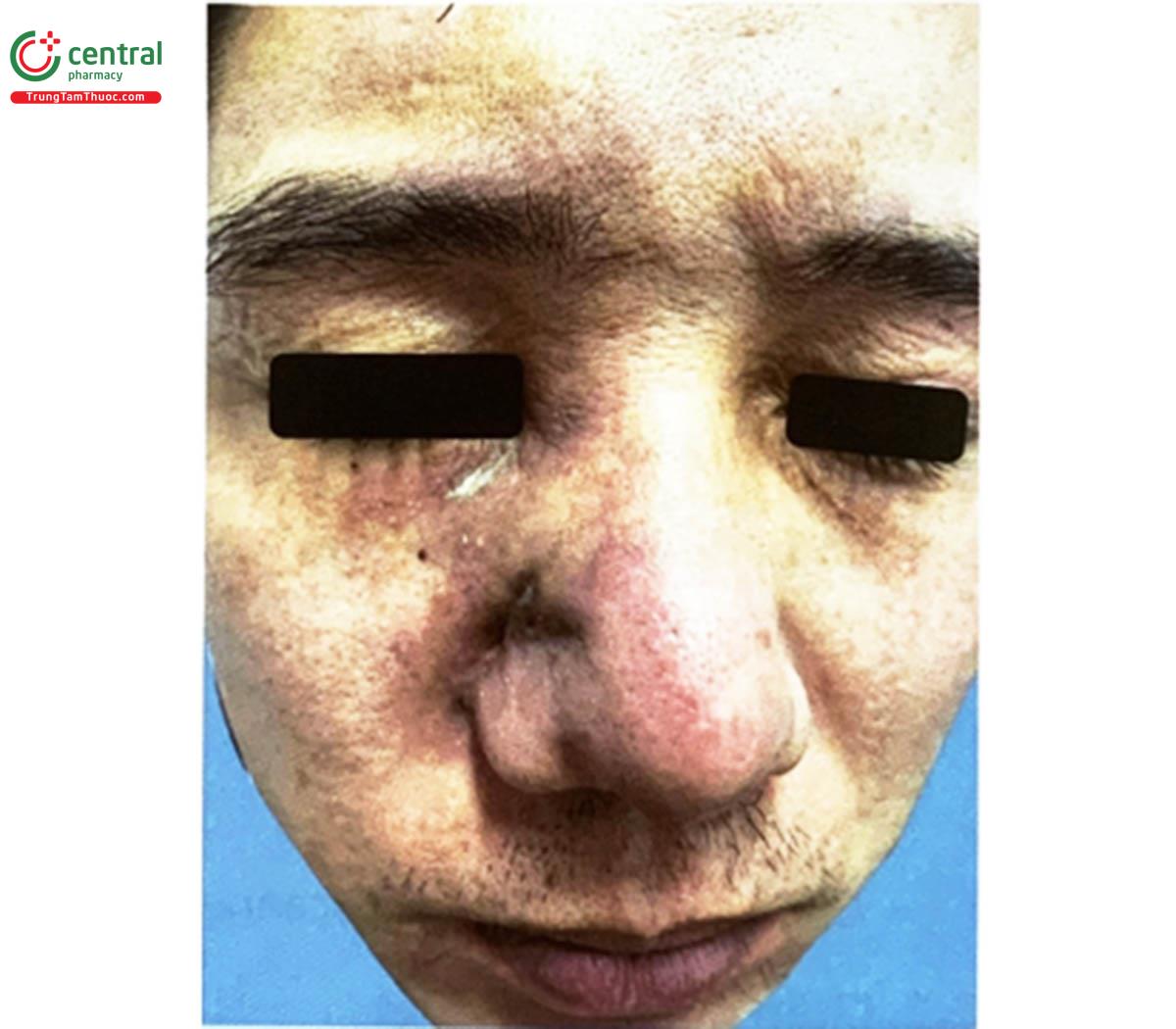 Hình 5.20. Bệnh nhân bị bệnh nắm Conidiobolomycosis ở vùng mũi khám và điều trị tại Khoa Khám bệnh, Bệnh viện Da liễu Trung ương (Nguồn: tác giả)