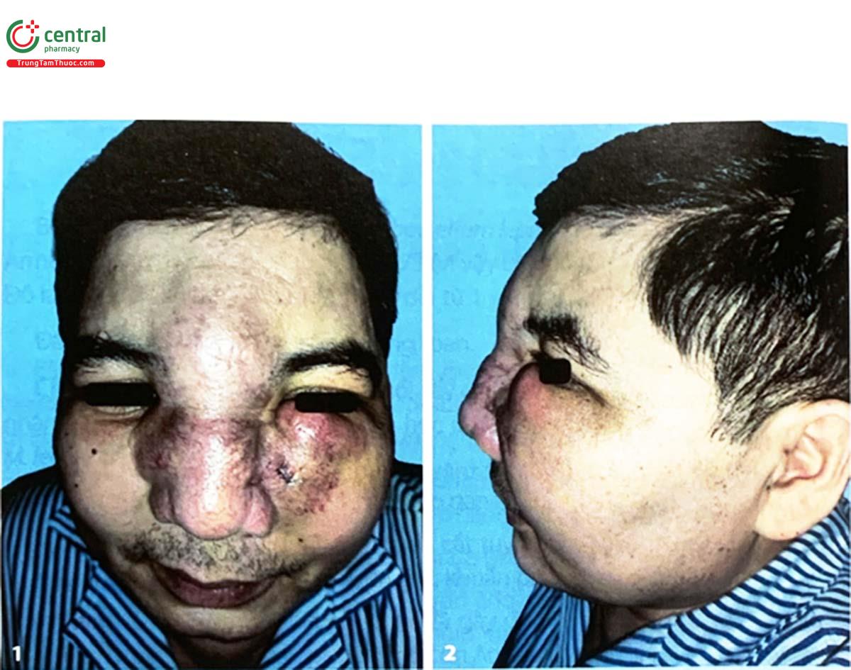 Hình 5.21. (1, 2) Bệnh nhân bị bệnh nấm Conidiobolomycosis vùng mũi gây biến dạng mặt được điều trị tại Khoa Bệnh da nam giới, Bệnh viện Da liễu Trung ương (Nguồn: tác giả)
