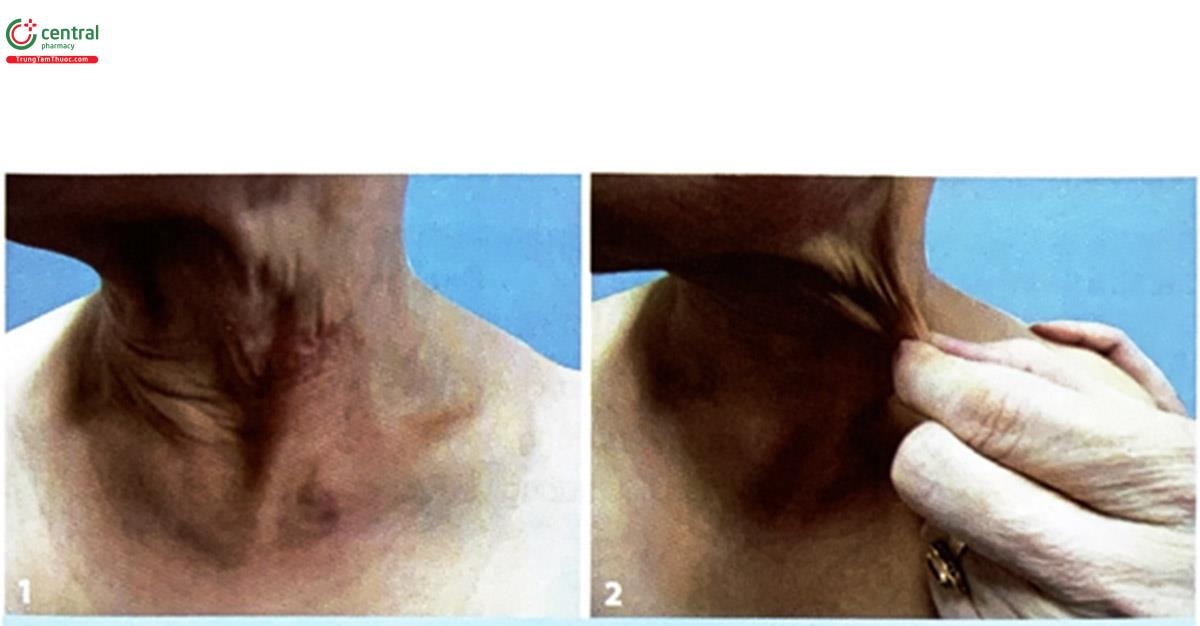 Hình 4.27. (1, 2) Bệnh nhân điều trị tại Bệnh viện Da liễu Trung ương với tổn thương da vùng cổ bị chảy xệ (Nguồn: tác giả)