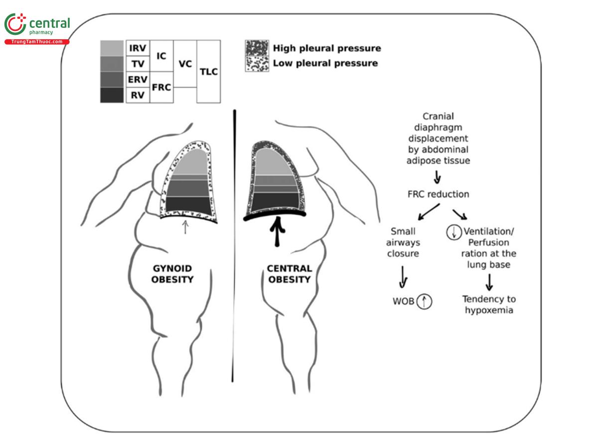 HÌNH 1. Béo phì mông đùi so với béo phì bụng. Béo phì mông đùi được phác họa ở bên trái và béo phì trung tâm ở bên phải. Màu sắc biểu thị thể tích phổi cổ điển và sự khác biệt giữa sự phân bổ béo phì ở vùng mông đùi và vùng trung tâm. Thể tích dự trữ thở ra (ERV) giảm đáng kể ở bệnh béo phì trung tâm, dẫn đến giảm dung tích cặn chức năng (FRC) và tổng dung tích phổi (TLC). Dung tích cặn (RV) không thay đổi. Thể tích khí lưu thông (TV) và dung tích hít vào (IC) chỉ giảm nhẹ. Cơ chế chính của hiện tượng này là sự dịch chuyển về phía đầu của cơ hoành bởi thành bụng (mũi tên dày ở phía béo trung tâm), dẫn đến tăng áp lực màng phổi (các điểm có mật độ cao, so với các điểm khan hiếm ở bệnh béo phì ở phụ khoa). bên). EELV, thể tích phối cuối thì thở ra; WOB, công thở.