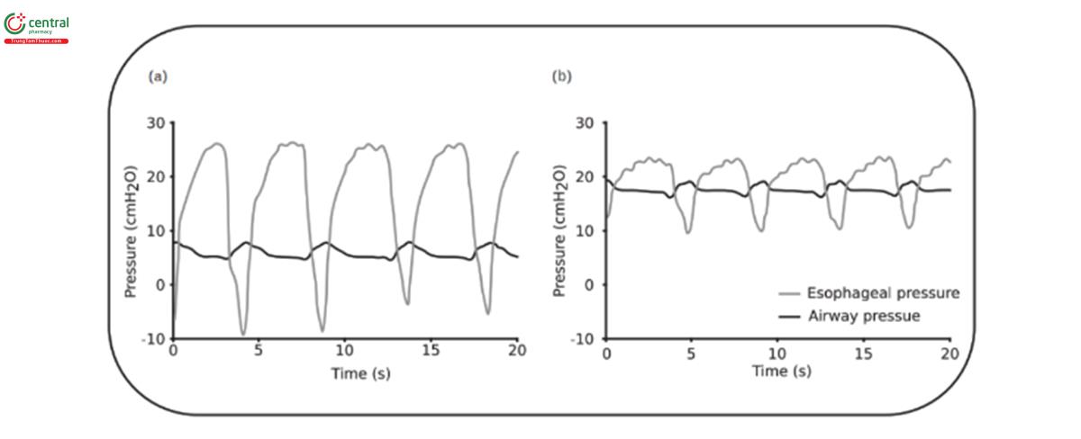 HÌNH 3. PEEP cho thử nghiệm thở tự nhiên thất bại và thành công. Đường cong áp lực thực quản và đường thở trong thử nghiệm thở tự nhiên (SBT): (A) với áp lực dương cuối thì thở ra (PEEP) là 5 cmH2O (SBT thất bại) và (B) với PEEP là 16 cmH2O (SBT thành công).