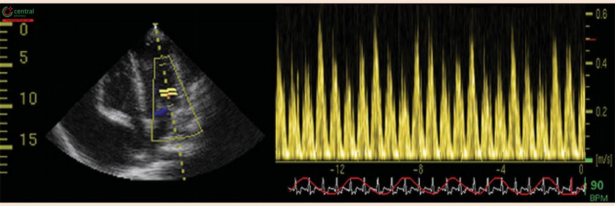 Hutchison, Stuart J. Bệnh màng ngoài tim: Atlas chẩn đoán hình ảnh lâm sàng, Philadelphia, Saunders, Elsevier, 2009. Ghi lại dòng chảy vào thất trái cho thấy sự thay đổi tốc độ dòng vào của sóng E > 25%