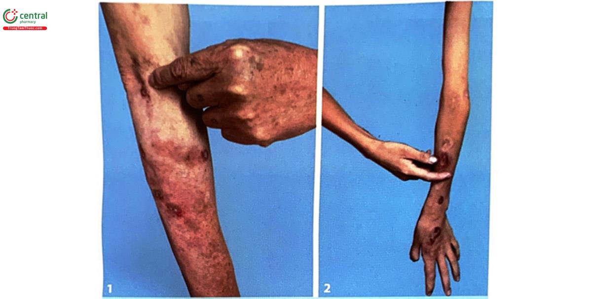 Hình 3.2. (1, 2) Viêm da do ảo giác trên bệnh nhân tại Bệnh viện Da liễu Trung ương năm 2019 (Nguồn: tác giả)