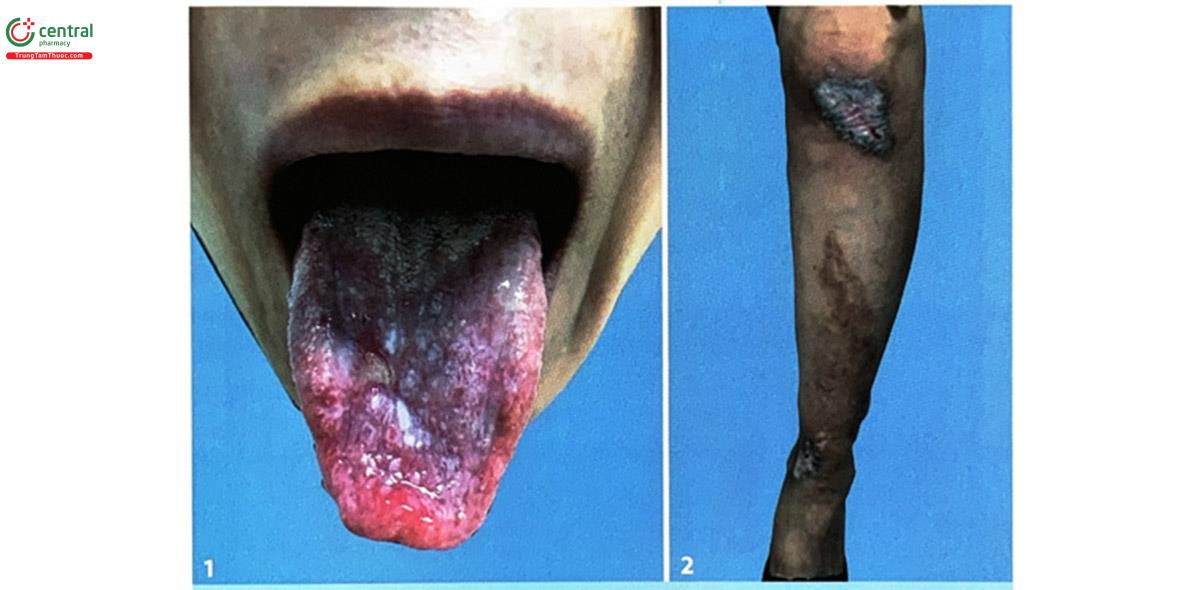 Hình 3.1. (1, 2) Viêm lưỡi và viêm da tự tạo trên bệnh nhân tại Bệnh viện Da liễu Trung ương năm 2020 (Nguồn: tác giả)