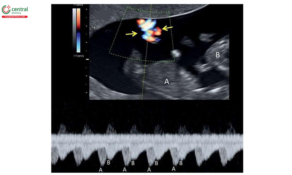 Hình 7.10: Song thai một màng đệm - một màng ối (A và B) lúc 13 tuần tuổi với dây rốn mắc nhau trên Doppler màu và xung. Lưu ý, có một khối dây rốn (mũi tên) trên Doppler màu. Doppler xung với cửa sổ rộng xác nhận dây rốn mắc nhau vì thấy hai dạng sóng Doppler riêng biệt (A và B) trong cùng một phổ Doppler.