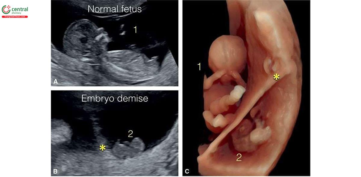 Hình 7.12: Song thai hai màng đệm lúc 13 tuần tuổi với thai nhi bình thường (1), cho thấy ở A trên mặt cắt dọc giữa và một phôi thai nhỏ đã chết (2), cho thấy trên siêu âm 2D ở B. Siêu âm 3D ở chế độ bề mặt ( C), cho thấy thai nhi (1) và (2), được ngăn cách nhau bởi một màng ngăn dày (dấu hoa thị).