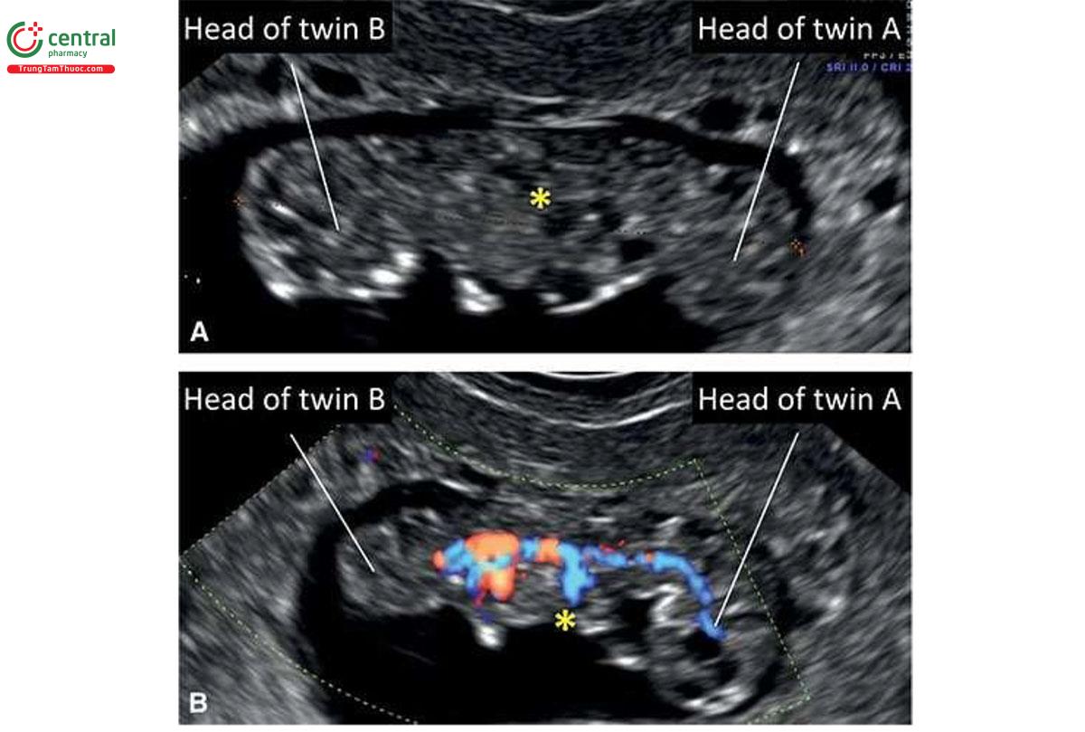 Hình 7.16: Song thai dính nhau trên siêu âm 2D lúc 9 tuần tuổi (A). Lưu ý, song thai dính nhau ở vùng chậu (dấu hoa thị). Vùng đầu của song thai được chú thích. B: Song thai dính nhau với siêu âm Doppler màu xác nhận sự kết nối mạch máu giữa 2 phôi (dấu hoa thị). Doppler màu có thể được dùng để xác định chẩn đoán song thai dính nhau và phân biệt nó với các phôi không dính nhau trong song thai một màng ối mà nằm sát nhau trong khoang ối. Vùng đầu của song thai được chú thích. 