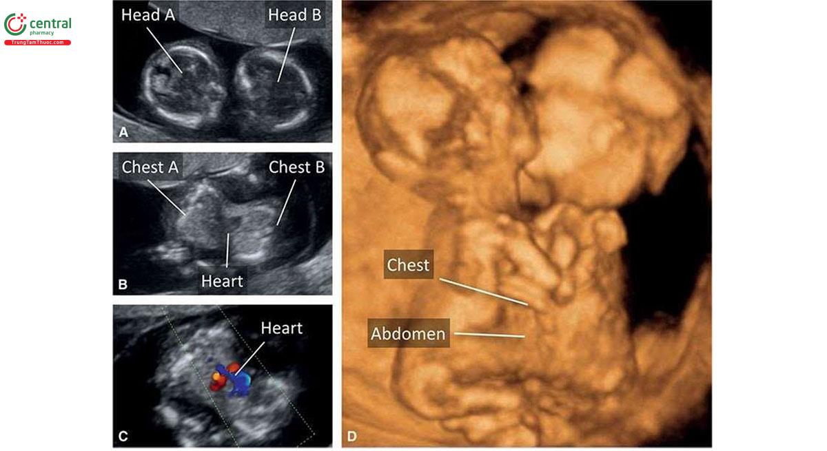 Hình 7.17: Song thai dính nhau ở vùng ngực thường có đầu ở gần nhau (A). Ở mức ngực, tim bất thường được dùng chung bởi cả 2 thai như cho thấy ở B và trong Doppler màu ở C. Siêu âm 3D ở chế độ bề mặt (D) cho thấy một song thai khác dính nhau ở vùng ngực và bụng lúc 12 tuần tuổi.