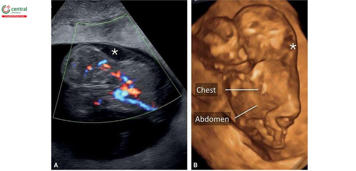 Hình 7.18: Song thai dính nhau ở vùng ngực lúc 10 tuần tuổi với tim dính nhau trên Doppler màu ở mặt cắt dọc (A) và siêu âm 3D ở chế độ bề mặt (B). Độ mờ da gáy dày (dấu hoa thị) ở cả 2 thai nhi.