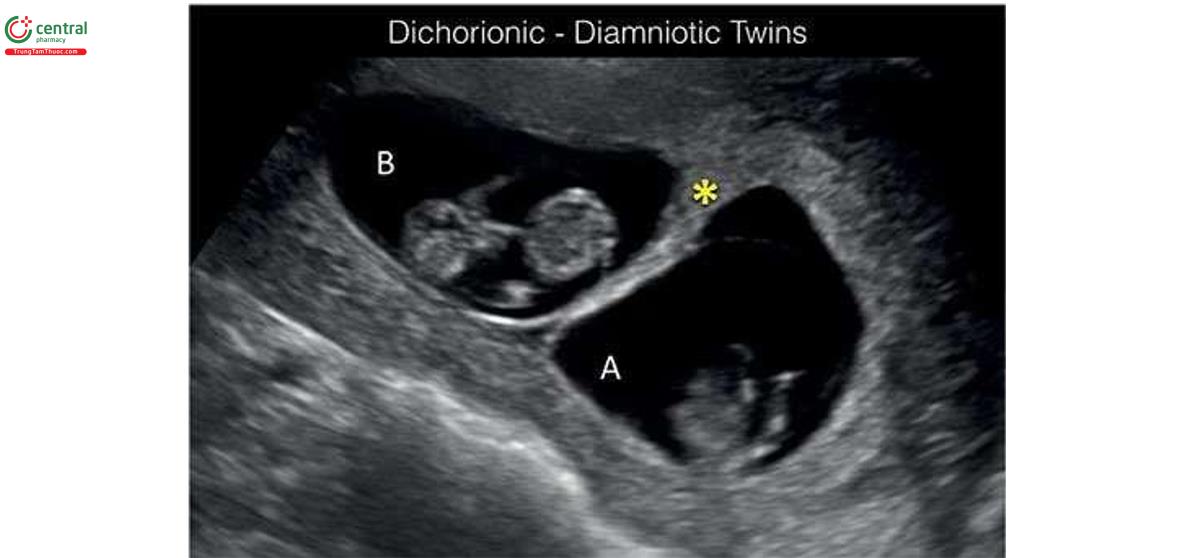 Hình 7.3: Song thai hai màng đệm-hai màng ối (A và B) lúc 11 tuần tuổi. Lưu ý, màng ngăn dày với dấu hiệu twin-peak (dấu hoa thị) ở vị trí các màng cắm vào nhau thai.